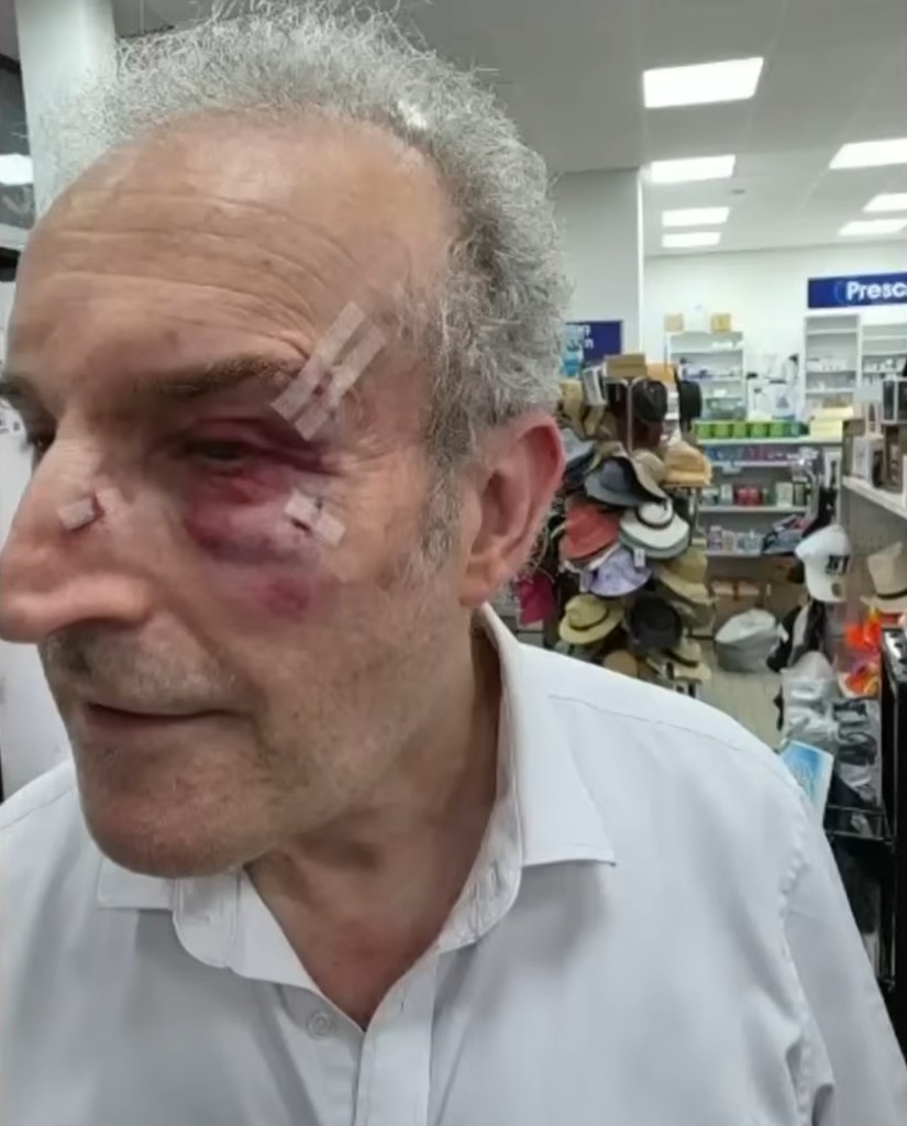 Russell Frajman, the St Kilda pharmacy owner, with facial injuries after the assault